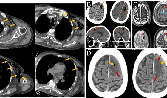 Paciente con gangrena gaseosa por Clostridium septicum desarrolla embolia cerebral aérea