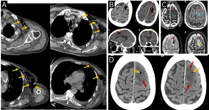 Paciente con gangrena gaseosa por Clostridium septicum desarrolla embolia cerebral aérea