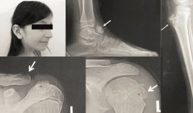 Presentación atípica de metachondromatosis en paciente pediátrica con tumor en el talo, tibia y clavícula