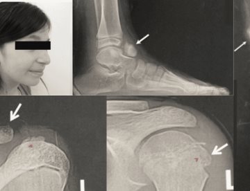 Presentación atípica de metachondromatosis en paciente pediátrica con tumor en el talo, tibia y clavícula