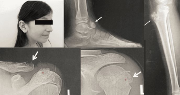 Presentación atípica de metachondromatosis en paciente pediátrica con tumor en el talo, tibia y clavícula