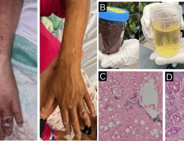 Coexistencia de porfiria cutánea tardía y LES en paciente inmunosuprimida postrasplante renal