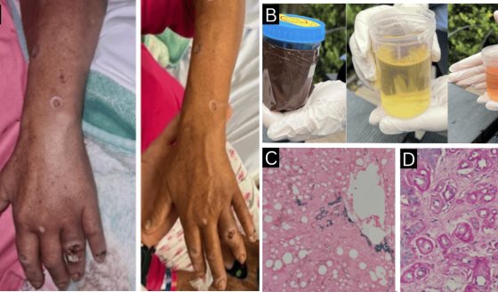Coexistencia de porfiria cutánea tardía y LES en paciente inmunosuprimida postrasplante renal