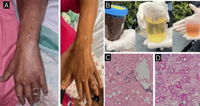 Coexistencia de porfiria cutánea tardía y LES en paciente inmunosuprimida postrasplante renal