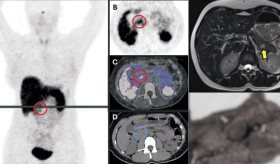 Hipoglucemia, convulsiones y síndrome de Munchausen tras pancreatectomía por insulinoma en mujer joven
