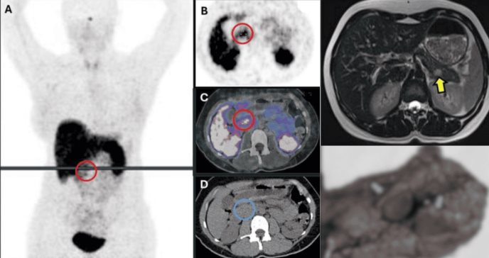 Hipoglucemia, convulsiones y síndrome de Munchausen tras pancreatectomía por insulinoma en mujer joven