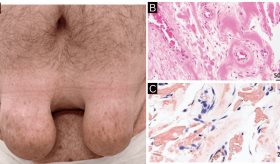 Hombre de 47 años presenta amiloidosis dérmica secundaria por uso crónico de insulina subcutánea