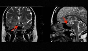 Meningioma selar simula patología hipofisaria en mujer de 45 años bajo tratamiento de fertilidad