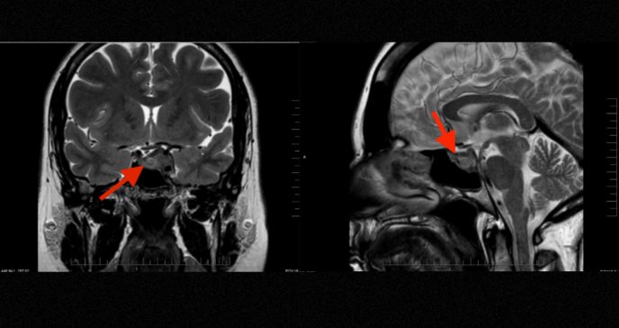 Meningioma selar simula patología hipofisaria en mujer de 45 años bajo tratamiento de fertilidad