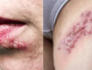 ¿Cómo se ve el herpes? 