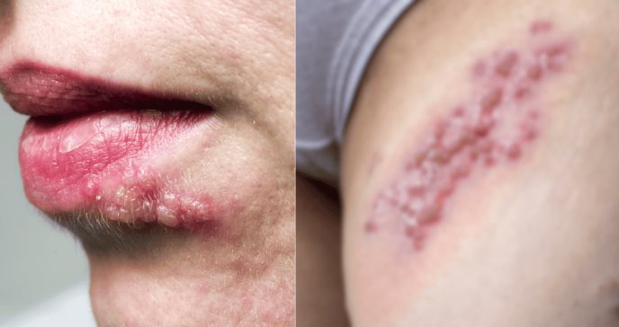 ¿Cómo se ve el herpes? 