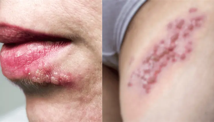 &iquest;C&oacute;mo se ve el herpes? 