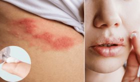 ¿Cómo y cuándo tomar o usar aciclovir?