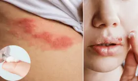 ¿Cómo y cuándo tomar o usar aciclovir?