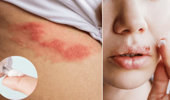 ¿Cómo y cuándo tomar o usar aciclovir?