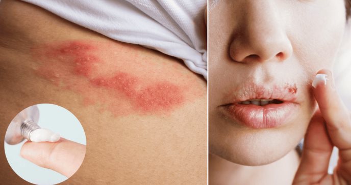¿Cómo y cuándo tomar o usar aciclovir?