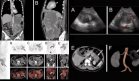 Liposarcoma mixoide renal con invasión pancreática y recurrencia fulminante en paciente con hipertensión