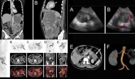 Liposarcoma mixoide renal con invasión pancreática y recurrencia fulminante en paciente con hipertensión