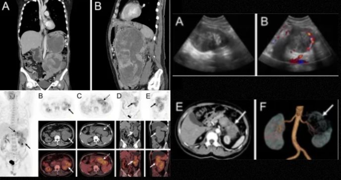 Liposarcoma mixoide renal con invasión pancreática y recurrencia fulminante en paciente con hipertensión