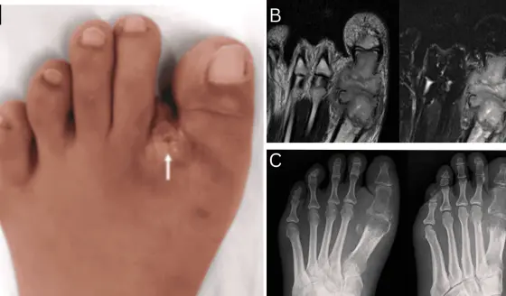 Manejo exitoso de tuberculosis ósea en articulación metatarsofalángica en paciente inmunocompetente