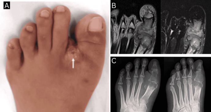Manejo exitoso de tuberculosis ósea en articulación metatarsofalángica en paciente inmunocompetente
