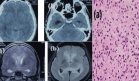 Detectan astrocitoma anaplásico en joven con hipertensión intracraneal, rigidez nucal y alteración mental