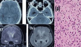 Detectan astrocitoma anaplásico en joven con hipertensión intracraneal, rigidez nucal y alteración mental