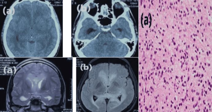 Detectan astrocitoma anaplásico en joven con hipertensión intracraneal, rigidez nucal y alteración mental