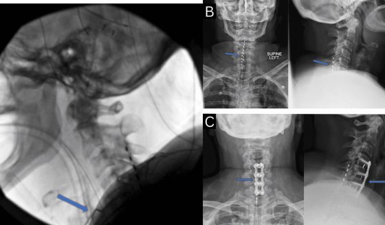 Fibrosis epidural como causa de mielopatía en paciente con síndrome de dolor tratado con ECP