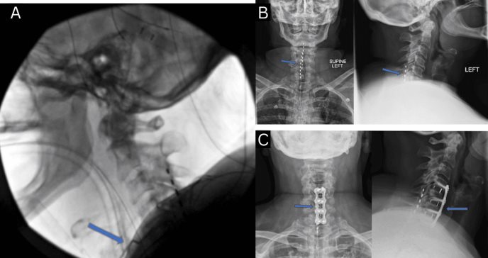 Fibrosis epidural como causa de mielopatía en paciente con síndrome de dolor tratado con ECP