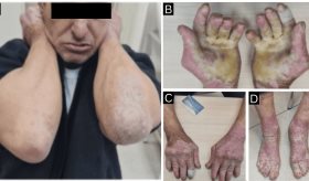 Hombre con hiperqueratosis epidermolítica desarrolla artritis inflamatoria y responde a metotrexato