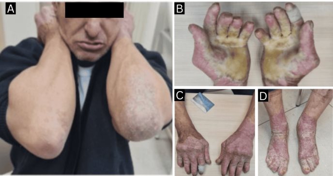 Hombre con hiperqueratosis epidermolítica desarrolla artritis inflamatoria y responde a metotrexato