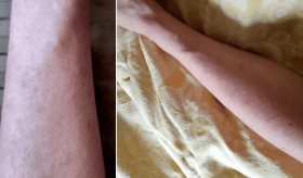 Erupción cutánea papular eritematosa con prurito como señal inicial de COVID-19 en profesional sanitaria