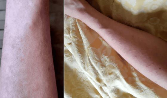 Erupción cutánea papular eritematosa con prurito como señal inicial de COVID-19 en profesional sanitaria