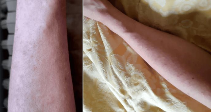 Erupción cutánea papular eritematosa con prurito como señal inicial de COVID-19 en profesional sanitaria