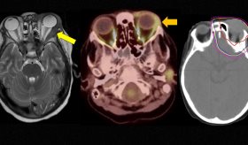 Sarcoma orbitario como recaída extramedular en paciente pediátrico con leucemia mieloide post-trasplante