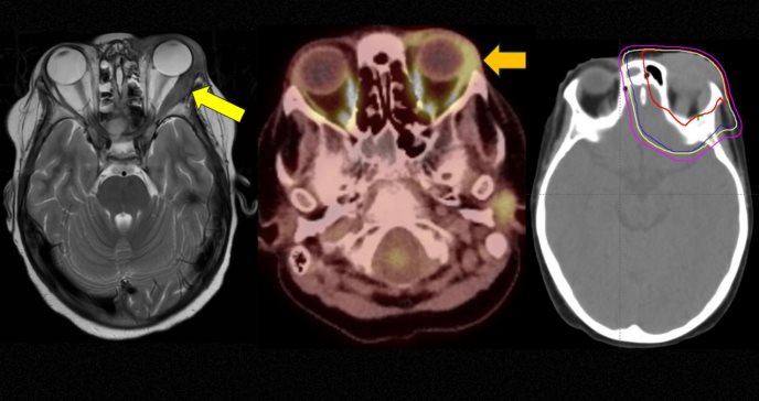 Sarcoma orbitario como recaída extramedular en paciente pediátrico con leucemia mieloide post-trasplante