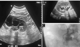 Obstrucción ureteropélvica bilateral secundaria a nefrolitiasis como causa de crisis hipertensiva