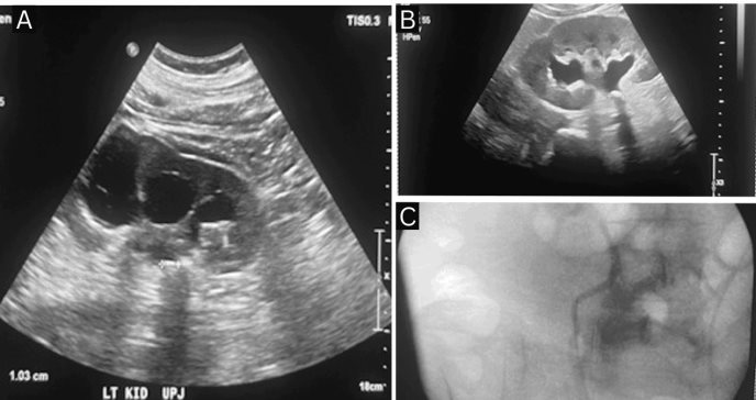 Obstrucción ureteropélvica bilateral secundaria a nefrolitiasis como causa de crisis hipertensiva