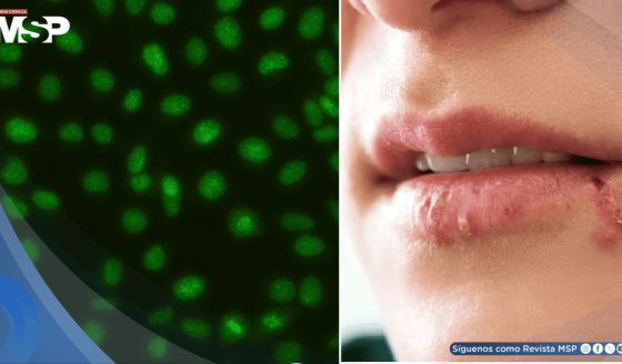 El bloqueo de la enzima topoisomerasa I podría detener la infección por herpes simple tipo 1
