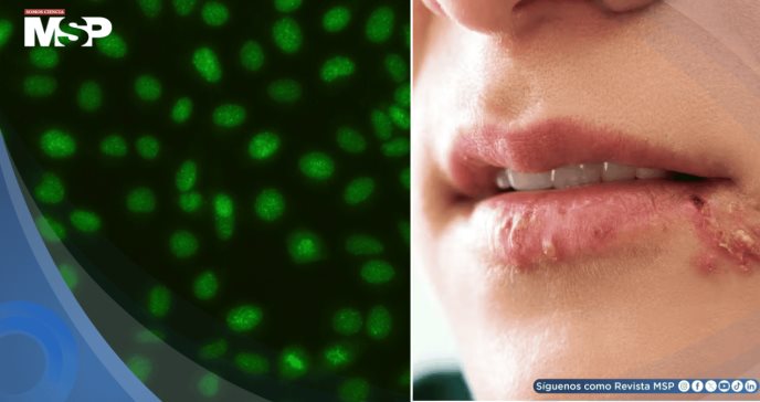 El bloqueo de la enzima topoisomerasa I podría detener la infección por herpes simple tipo 1