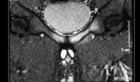 Atleta de 24 años desarrolla osteomielitis púbica por bacteria oral tras extracción dental