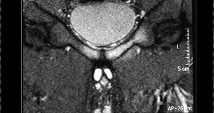 Atleta de 24 años desarrolla osteomielitis púbica por bacteria oral tras extracción dental