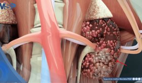 La inmunoterapia eleva al 40% la supervivencia a 5 años en cáncer renal metastásico, según expertos  