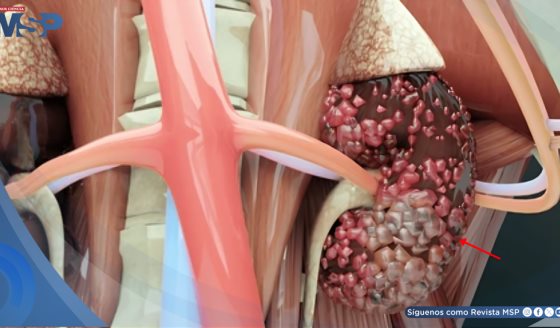 La inmunoterapia eleva al 40% la supervivencia a 5 años en cáncer renal metastásico, según expertos  