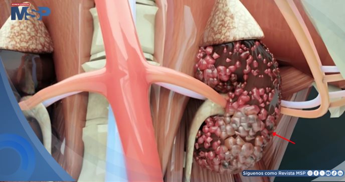 La inmunoterapia eleva al 40% la supervivencia a 5 años en cáncer renal metastásico, según expertos  