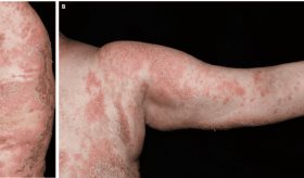 Paciente con cáncer de mama presenta psoriasis pustulosa generalizada tras suspender glucocorticoides 