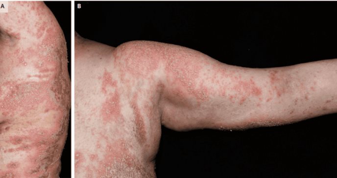 Paciente con cáncer de mama presenta psoriasis pustulosa generalizada tras suspender glucocorticoides 