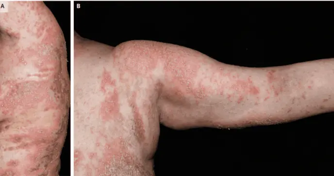 Paciente con cáncer de mama presenta psoriasis pustulosa generalizada tras suspender glucocorticoides 