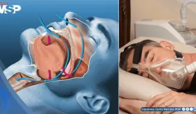 Alteraciones circadianas por altas temperaturas: nuevo factor de aparición de la apnea del sueño